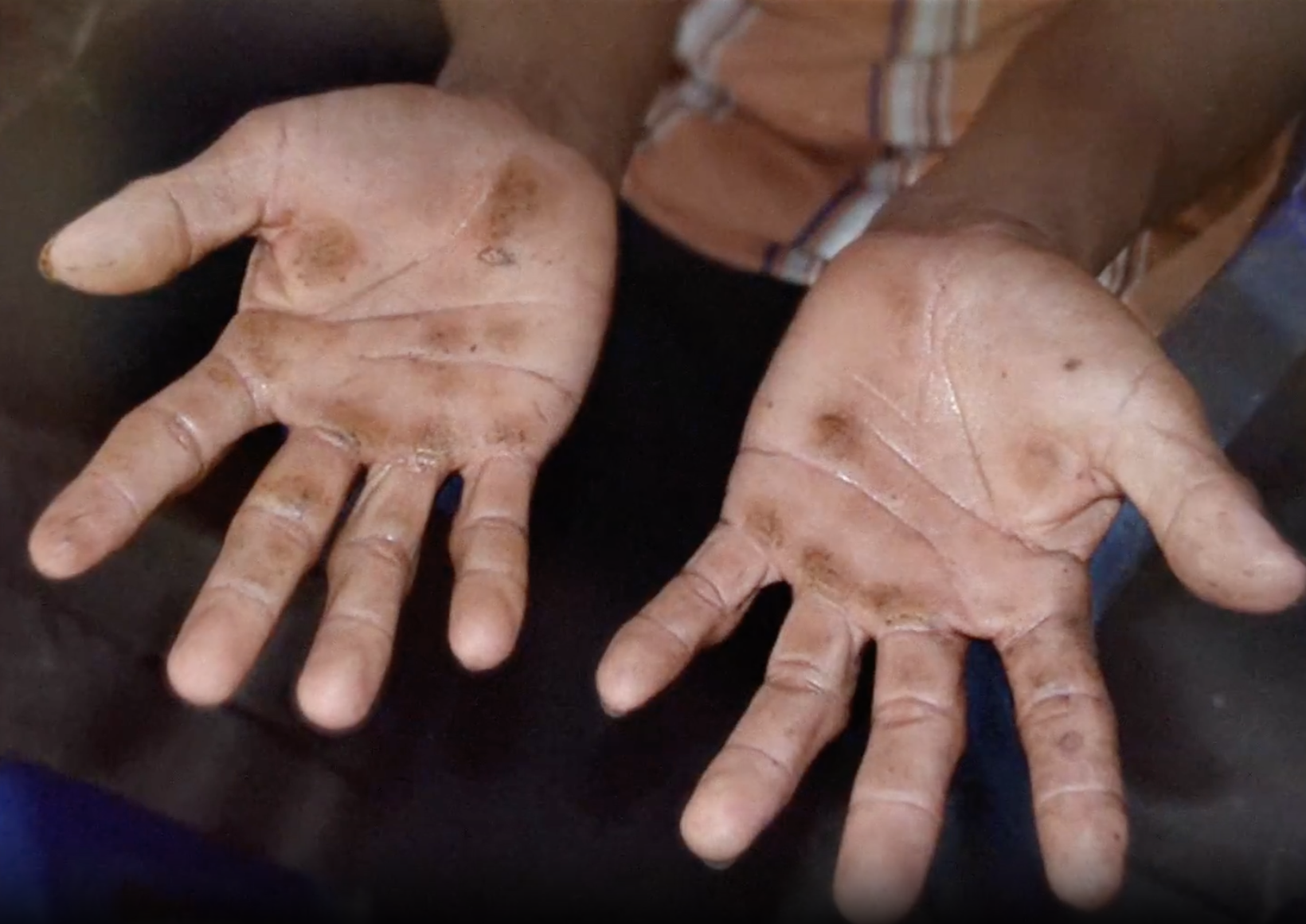 Close-up of hands showing lesions from toxic exposure